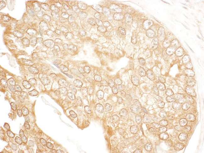 UBR4 Antibody - Detection of Human p600 by Immunohistochemistry. Sample: FFPE section of human prostate carcinoma. Antibody: Affinity purified rabbit anti-p600 used at a dilution of 1:200 (1 ug/ml). Detection: DAB.