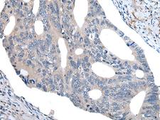UBR4 Antibody - Immunohistochemistry of paraffin-embedded Human colorectal cancer tissue  using UBR4 Polyclonal Antibody at dilution of 1:55(×200)