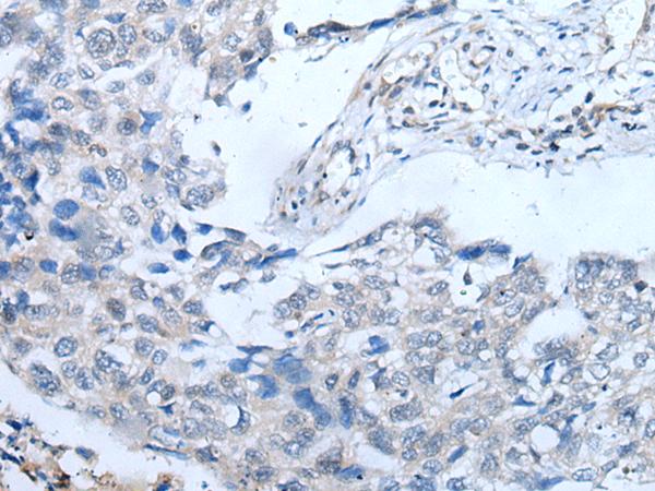 UBR4 Antibody - Immunohistochemistry of paraffin-embedded Human lung cancer tissue  using UBR4 Polyclonal Antibody at dilution of 1:65(×200)