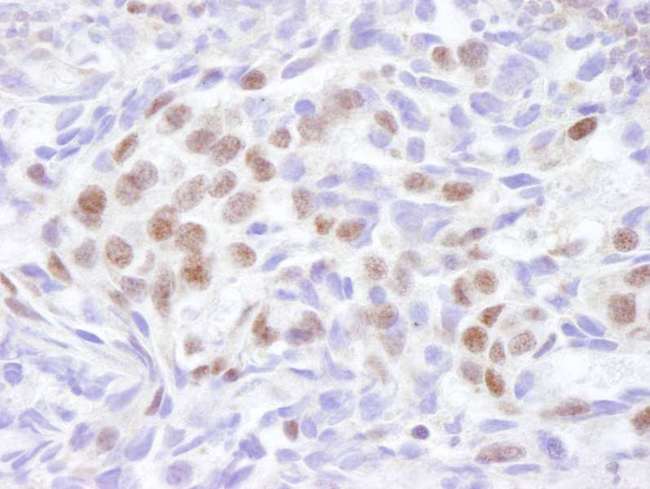 UBR5 Antibody - Detection of Human EDD1 by Immunohistochemistry. Sample: FFPE section of human breast adenocarcinoma. Antibody: Affinity purified rabbit anti-EDD1 used at a dilution of 1:100. Detection: DAB.