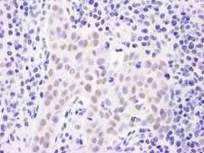 UBR5 Antibody - Detection of Human EDD1 by Immunohistochemistry. Sample: FFPE section of human lung carcinoma. Antibody: Affinity purified rabbit anti-EDD1 used at a dilution of 1:1000 (1 ug/ml). Detection: DAB.