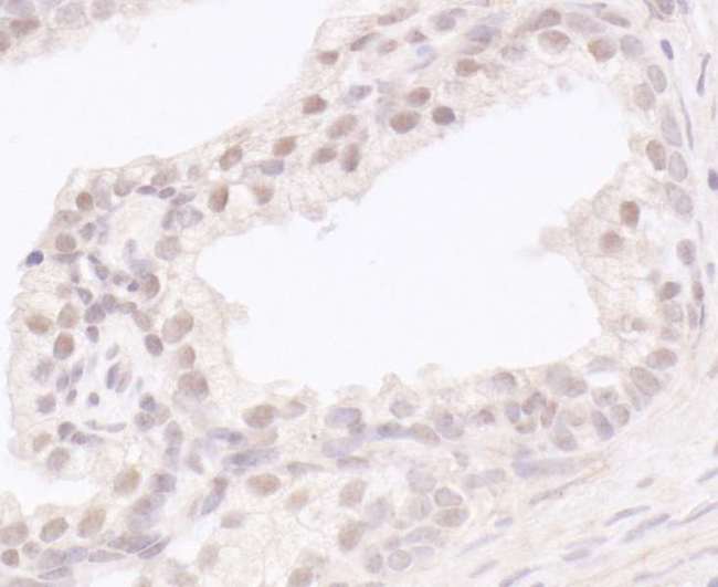 UBR5 Antibody - Detection of human EDD1 by immunohistochemistry. Sample: FFPE section of human prostate carcinoma. Antibody: Affinity purified rabbit anti-EDD1 used at a dilution of 1:1,000 (1µg/ml). Detection: DAB