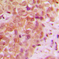 UBR5 Antibody - Immunohistochemical analysis of UBR5 staining in human breast cancer formalin fixed paraffin embedded tissue section. The section was pre-treated using heat mediated antigen retrieval with sodium citrate buffer (pH 6.0). The section was then incubated with the antibody at room temperature and detected using an HRP conjugated compact polymer system. DAB was used as the chromogen. The section was then counterstained with hematoxylin and mounted with DPX.