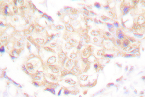 UBR5 Antibody - IHC of EDD (T14) pAb in paraffin-embedded human breast carcinoma tissue.