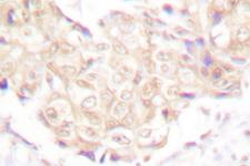 UBR5 Antibody - IHC of EDD (T14) pAb in paraffin-embedded human breast carcinoma tissue.