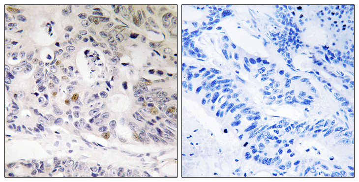 UBTD1 Antibody - Immunohistochemistry analysis of paraffin-embedded human colon carcinoma tissue, using UBTD1 Antibody. The picture on the right is blocked with the synthesized peptide.