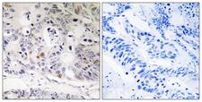UBTD1 Antibody - Immunohistochemistry analysis of paraffin-embedded human colon carcinoma tissue, using UBTD1 Antibody. The picture on the right is blocked with the synthesized peptide.