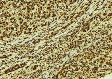 UBTF / UBF Antibody - 1:100 staining human breast carcinoma tissue by IHC-P. The sample was formaldehyde fixed and a heat mediated antigen retrieval step in citrate buffer was performed. The sample was then blocked and incubated with the antibody for 1.5 hours at 22°C. An HRP conjugated goat anti-rabbit antibody was used as the secondary.