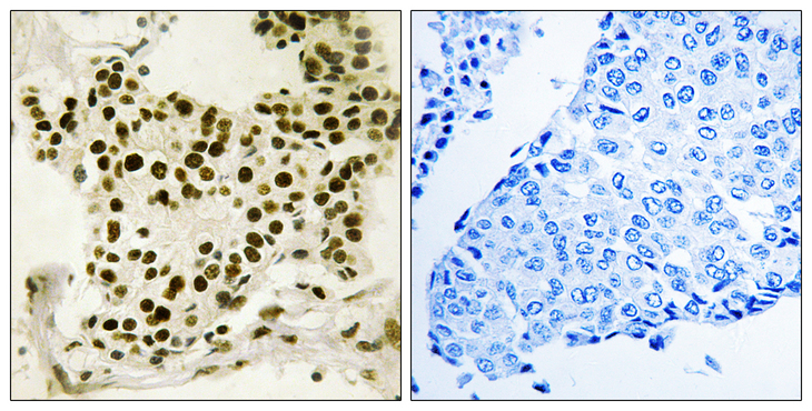 UBTF / UBF Antibody - Immunohistochemistry analysis of paraffin-embedded human breast carcinoma, using UBF (Phospho-Ser484) Antibody. The picture on the right is blocked with the phospho peptide.