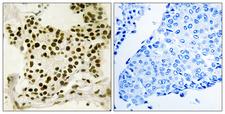 UBTF / UBF Antibody - P-peptide - + Immunohistochemistry analysis of paraffin-embedded human breast carcinoma tissue using UBF (Phospho-Ser484) antibody.
