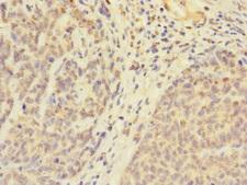 UBXD6 Antibody - Immunohistochemistry of paraffin-embedded human ovarian cancer using UBXN8 Antibody at dilution of 1:100