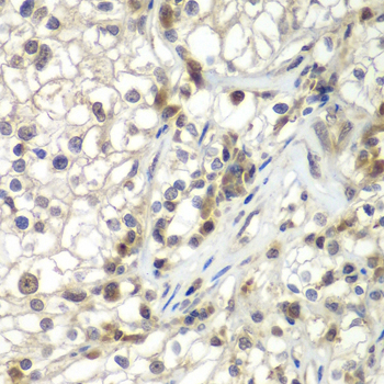 UBXD9 / ASPL Antibody - Immunohistochemistry of paraffin-embedded human kidney cancer tissue.