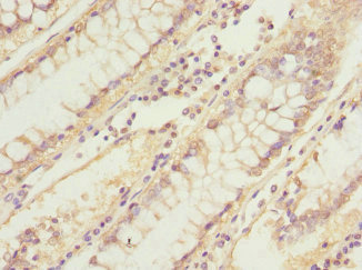 UBXD9 / ASPL Antibody - Immunohistochemistry of paraffin-embedded human colon cancer at dilution 1:100