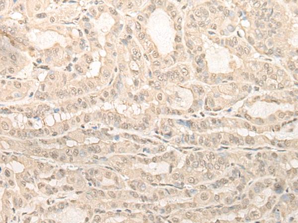 UBXN1 Antibody - Immunohistochemistry of paraffin-embedded Human thyroid cancer tissue  using UBXN1 Polyclonal Antibody at dilution of 1:35(×200)