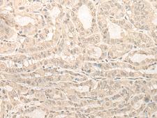 UBXN1 Antibody - Immunohistochemistry of paraffin-embedded Human thyroid cancer tissue  using UBXN1 Polyclonal Antibody at dilution of 1:35(×200)