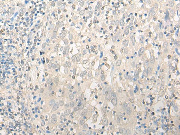 UBXN1 Antibody - Immunohistochemistry of paraffin-embedded Human cervical cancer tissue  using UBXN1 Polyclonal Antibody at dilution of 1:35(×200)