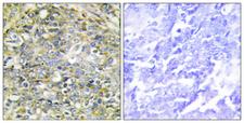 UBXN11 / SOC Antibody - Immunohistochemistry analysis of paraffin-embedded human lung carcinoma tissue, using UBXD5 Antibody. The picture on the right is blocked with the synthesized peptide.