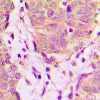 UBXN11 / SOC Antibody - Immunohistochemical analysis of UBXN11 staining in human breast cancer formalin fixed paraffin embedded tissue section. The section was pre-treated using heat mediated antigen retrieval with sodium citrate buffer (pH 6.0). The section was then incubated with the antibody at room temperature and detected using an HRP conjugated compact polymer system. DAB was used as the chromogen. The section was then counterstained with hematoxylin and mounted with DPX.