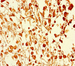 UBXN2B Antibody - Immunohistochemistry of paraffin-embedded human melanoma using UBXN2B Antibody at dilution of 1:100