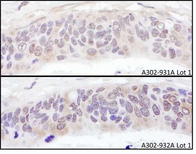 UBXN6 / UBXD1 Antibody - Detection of Human UBXD1 by Immunohistochemistry. Samples: FFPE serial sections of human ovarian carcinoma. Antibody: Affinity purified rabbit anti-UBXD1 used at a dilution of 1:1000 (1 ug/ml). Detection: DAB.