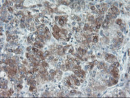 UCHL1 / PGP9.5 Antibody - IHC of paraffin-embedded Carcinoma of Human liver tissue using anti-UCHL1 mouse monoclonal antibody. (Heat-induced epitope retrieval by 10mM citric buffer, pH6.0, 100C for 10min).