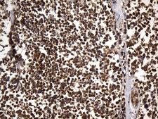 UCHL1 / PGP9.5 Antibody - Immunohistochemical staining of paraffin-embedded Carcinoma of Human lung tissue using anti-UCHL1. (PGP9.5) mouse monoclonal antibody. (Heat-induced epitope retrieval by 1mM EDTA in 10mM Tris buffer. (pH8.5) at 120°C for 3 min. (1:600)