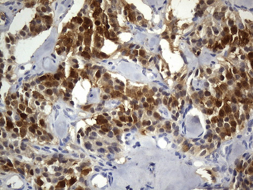 UCHL1 / PGP9.5 Antibody - Immunohistochemical staining of paraffin-embedded Carcinoma of Human pancreas tissue using anti-UCHL1. (PGP9.5) mouse monoclonal antibody. (Heat-induced epitope retrieval by 1mM EDTA in 10mM Tris buffer. (pH8.5) at 120°C for 3 min. (1:600)