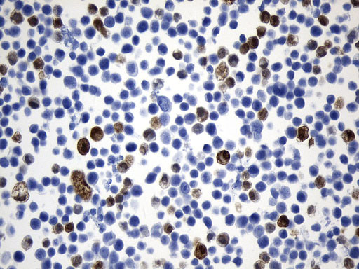 UCHL1 / PGP9.5 Antibody - Immunohistochemical staining of paraffin-embedded MCF7 cell pellets using anti-UCHL1. (PGP9.5) mouse monoclonal antibody. (Heat-induced epitope retrieval by 1mM EDTA in 10mM Tris buffer. (pH8.0) at 120°C for 2.5 min. (1:600)