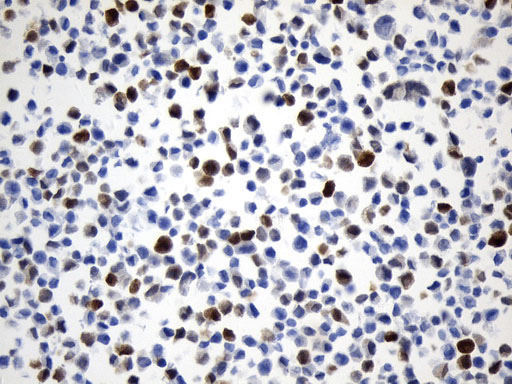 UCHL1 / PGP9.5 Antibody - Immunohistochemical staining of paraffin-embedded COS-7 cell pellets using anti-UCHL1. (PGP9.5) mouse monoclonal antibody. (Heat-induced epitope retrieval by 1mM EDTA in 10mM Tris buffer. (pH8.0) at 120°C for 2.5 min. (1:600)