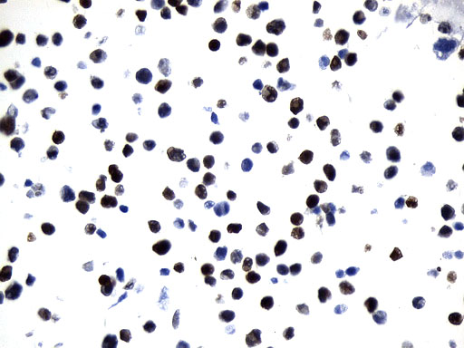 UCHL1 / PGP9.5 Antibody - Immunohistochemical staining of paraffin-embedded Huh7 cell pellets using anti-UCHL1. (PGP9.5) mouse monoclonal antibody. (Heat-induced epitope retrieval by 1mM EDTA in 10mM Tris buffer. (pH8.0) at 120°C for 2.5 min. (1:600)