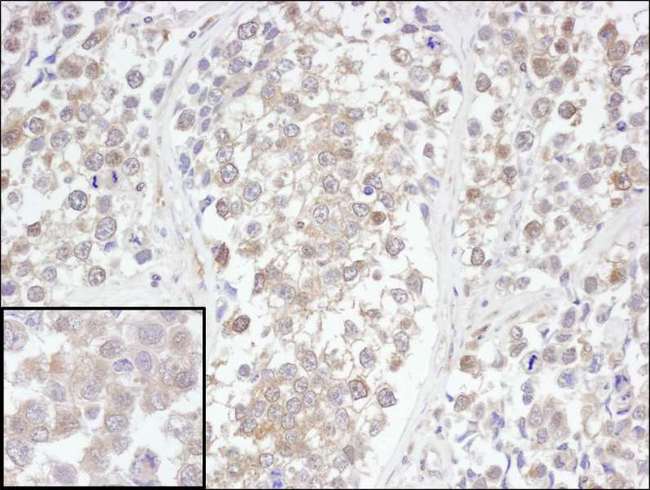 UCHL3 Antibody - Detection of Human UCH-L3 by Immunohistochemistry. Sample: FFPE section of human testicular seminoma. Antibody: Affinity purified rabbit anti-UCH-L3 used at a dilution of 1:200 (1 ug/ml). Detection: DAB.