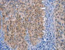 UCK1 Antibody - Immunohistochemistry of paraffin-embedded Human thyroid cancer using UCK1 Polyclonal Antibody at dilution of 1:50.