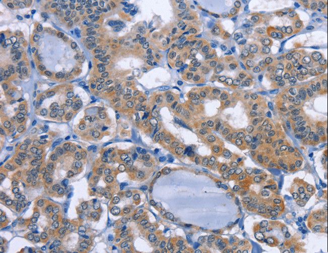 UCK1 Antibody - Immunohistochemistry of paraffin-embedded Human thyroid cancer using UCK1 Polyclonal Antibody at dilution of 1:50.