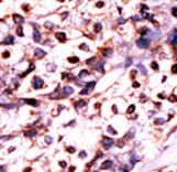 UCK2 Antibody - Formalin-fixed and paraffin-embedded human cancer tissue reacted with the primary antibody, which was peroxidase-conjugated to the secondary antibody, followed by DAB staining. This data demonstrates the use of this antibody for immunohistochemistry; clinical relevance has not been evaluated. BC = breast carcinoma; HC = hepatocarcinoma.
