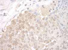 UCKL1 Antibody - Detection of Human UCKL1 by Immunohistochemistry. Sample: FFPE section of human prostate carcinoma. Antibody: Affinity purified rabbit anti-UCKL1 used at a dilution of 1:1000 (1 ug/mg).