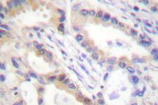 UCN / Urocortin Antibody - IHC of Urocortin (A103) pAb in paraffin-embedded human lung carcinoma tissue.