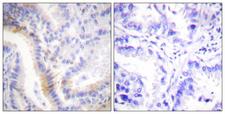 UCN / Urocortin Antibody - Peptide - + Immunohistochemistry analysis of paraffin-embedded human lung carcinoma tissue, using urocortin antibody.