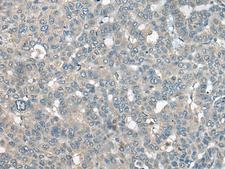 UCN3 / SPC Antibody - Immunohistochemistry of paraffin-embedded Human liver cancer tissue  using UCN3 Polyclonal Antibody at dilution of 1:55(×200)