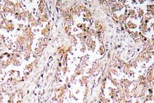 UCP2 Antibody - IHC of UCP2 (H113) pAb in paraffin-embedded human lung carcinoma tissue.