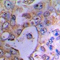 UCP2 Antibody - Immunohistochemical analysis of UCP2 staining in human lung cancer formalin fixed paraffin embedded tissue section. The section was pre-treated using heat mediated antigen retrieval with sodium citrate buffer (pH 6.0). The section was then incubated with the antibody at room temperature and detected using an HRP conjugated compact polymer system. DAB was used as the chromogen. The section was then counterstained with haematoxylin and mounted with DPX.