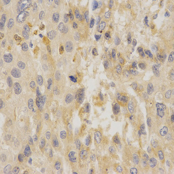 UCP3 Antibody - Immunohistochemistry of paraffin-embedded human liver cancer using UCP3 antibody at dilution of 1:200 (x400 lens).