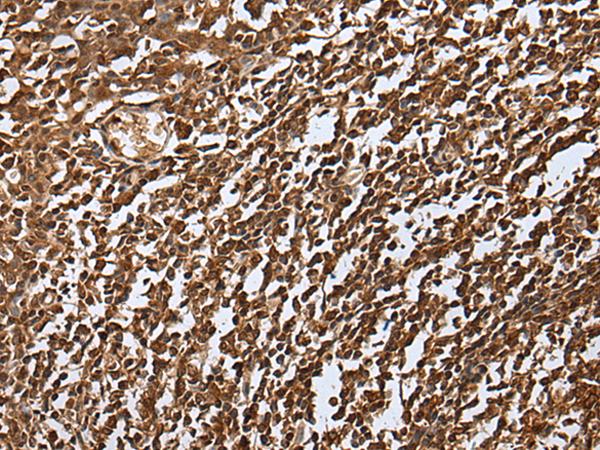 UEV1 / UEV1A Antibody - Immunohistochemistry of paraffin-embedded Human tonsil tissue  using UBE2V1 Polyclonal Antibody at dilution of 1:30(×200)