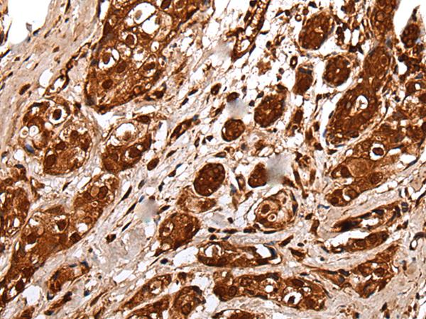 UEV1 / UEV1A Antibody - Immunohistochemistry of paraffin-embedded Human breast cancer tissue  using UBE2V1 Polyclonal Antibody at dilution of 1:30(×200)