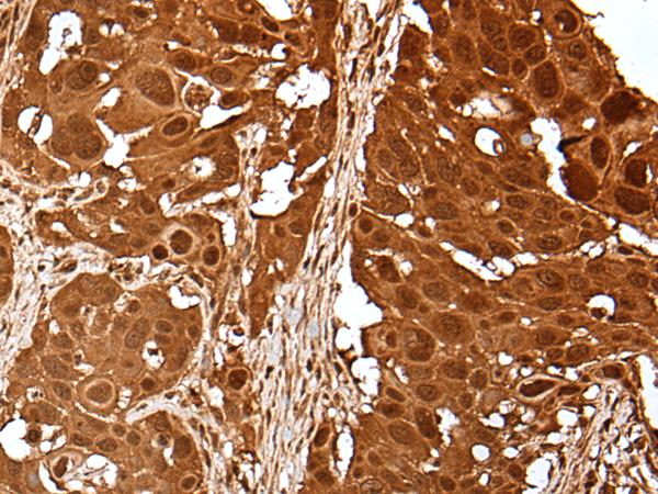 UEV1 / UEV1A Antibody - Immunohistochemistry of paraffin-embedded Human esophagus cancer tissue  using UBE2V1 Polyclonal Antibody at dilution of 1:40(×200)