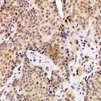 UEVLD Antibody - Immunohistochemical analysis of UEVLD staining in human breast cancer formalin fixed paraffin embedded tissue section. The section was pre-treated using heat mediated antigen retrieval with sodium citrate buffer (pH 6.0). The section was then incubated with the antibody at room temperature and detected using an HRP conjugated compact polymer system. DAB was used as the chromogen. The section was then counterstained with haematoxylin and mounted with DPX.