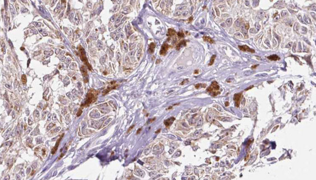 UEVLD Antibody - 1:100 staining human Melanoma tissue by IHC-P. The sample was formaldehyde fixed and a heat mediated antigen retrieval step in citrate buffer was performed. The sample was then blocked and incubated with the antibody for 1.5 hours at 22°C. An HRP conjugated goat anti-rabbit antibody was used as the secondary.