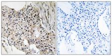 UEVLD Antibody - Peptide - + Immunohistochemistry analysis of paraffin-embedded human breast carcinoma tissue, using UEVLD antibody.