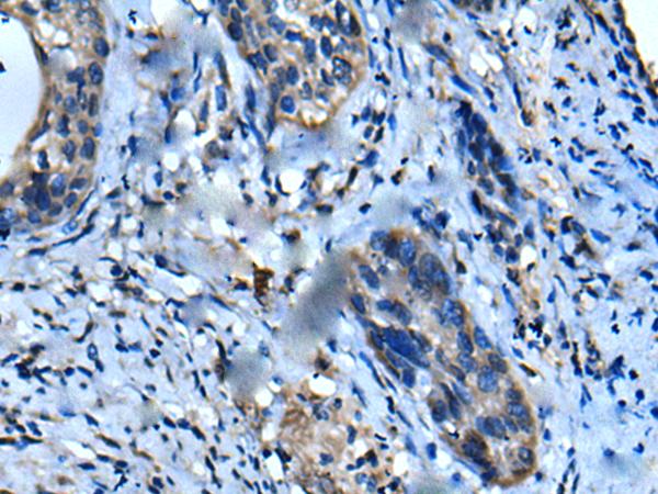 UFC1 Antibody - Immunohistochemistry of paraffin-embedded Human cervical cancer tissue  using UFC1 Polyclonal Antibody at dilution of 1:50(×200)