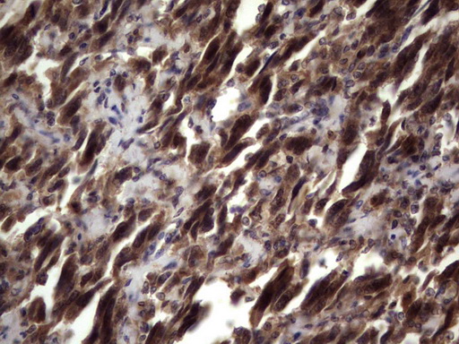 UFD1L Antibody - Immunohistochemical staining of paraffin-embedded Adenocarcinoma of Human ovary tissue using anti-UFD1L mouse monoclonal antibody. (Heat-induced epitope retrieval by 1 mM EDTA in 10mM Tris, pH8.5, 120C for 3min,