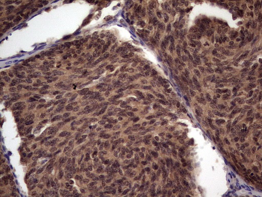 UFD1L Antibody - Immunohistochemical staining of paraffin-embedded Human thyroid tissue within the normal limits using anti-UFD1L mouse monoclonal antibody. (Heat-induced epitope retrieval by 1 mM EDTA in 10mM Tris, pH8.5, 120C for 3min,
